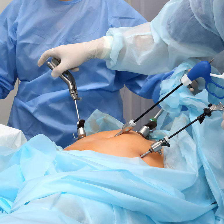Laparoscopic hysterectomy